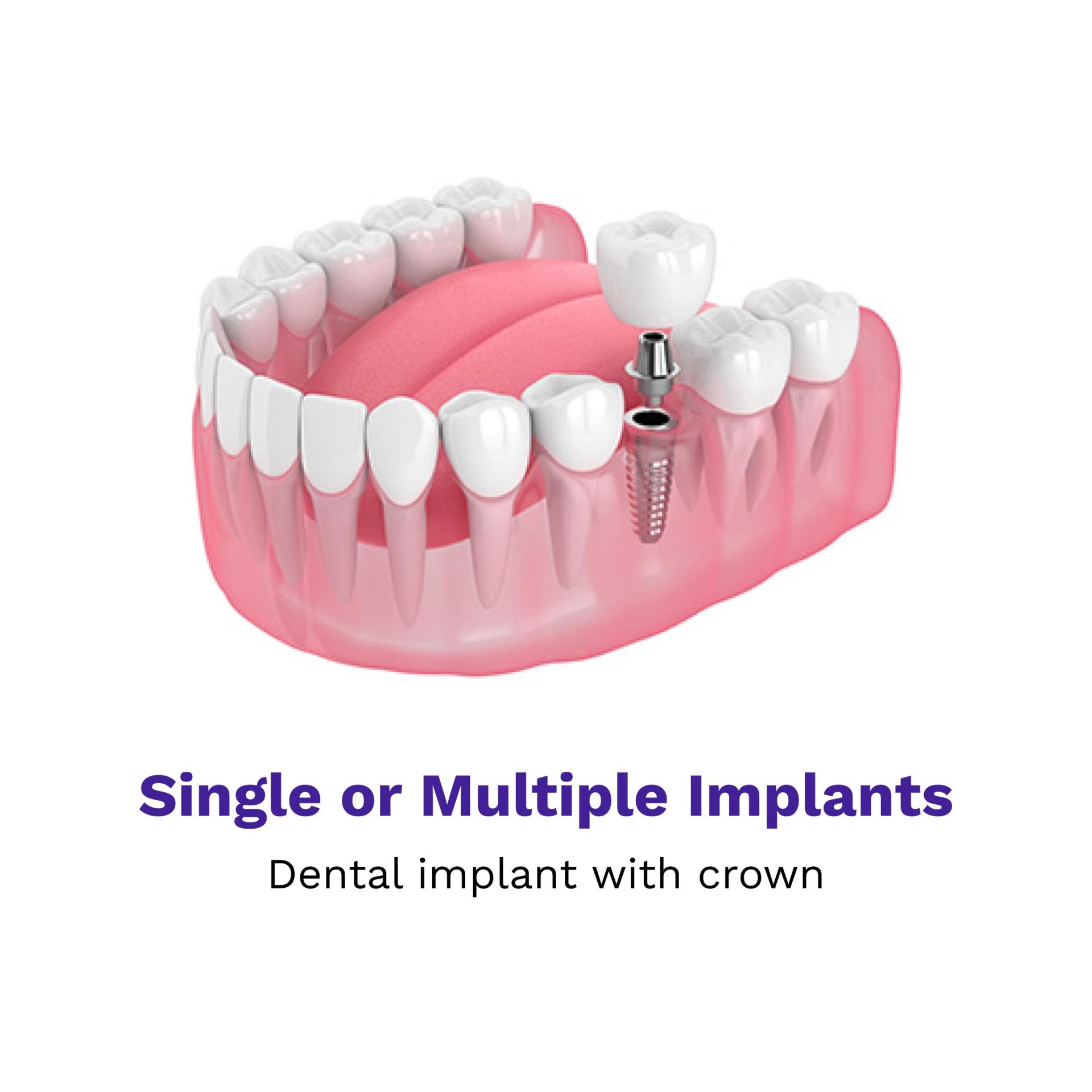 Single or multiple implants