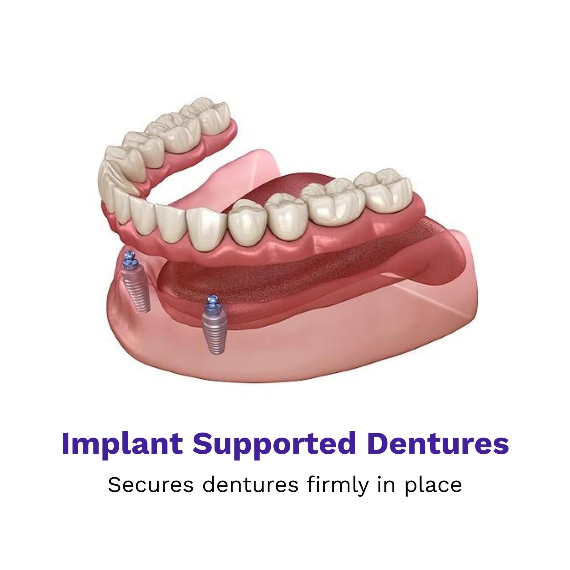 Implant Supported Dentures